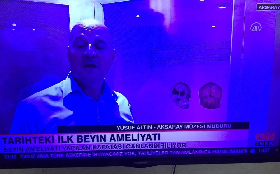 AKSARAY CNN TÜRKDE .TARİHDEKİ İLK AMELİYAT ANLATILDI.!